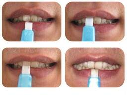 Средство для отбеливания зубов Teeth Cleaning Kit